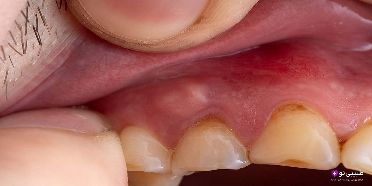 درمان ورم صورت در اثر دندان درد در طب سنتی