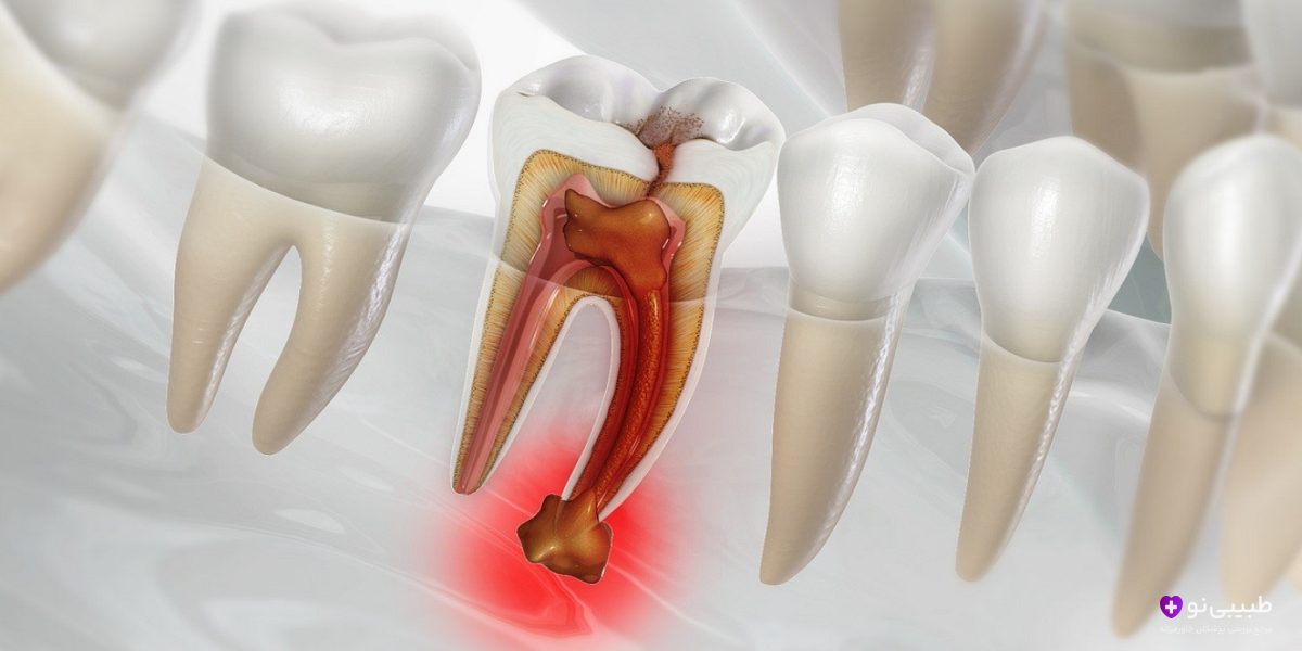 چند روز بعد از عصب کشی دندان را پر کنیم؟