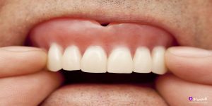 بعد از گذاشتن دندان مصنوعی چکار باید کرد؟