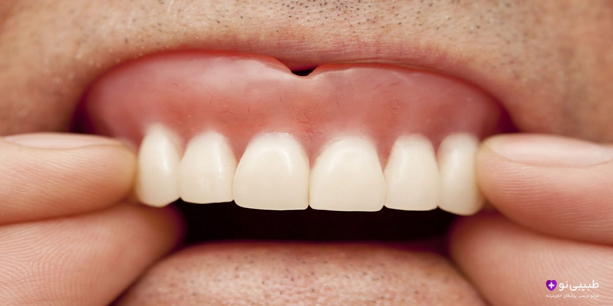بعد از گذاشتن دندان مصنوعی چکار باید کرد؟