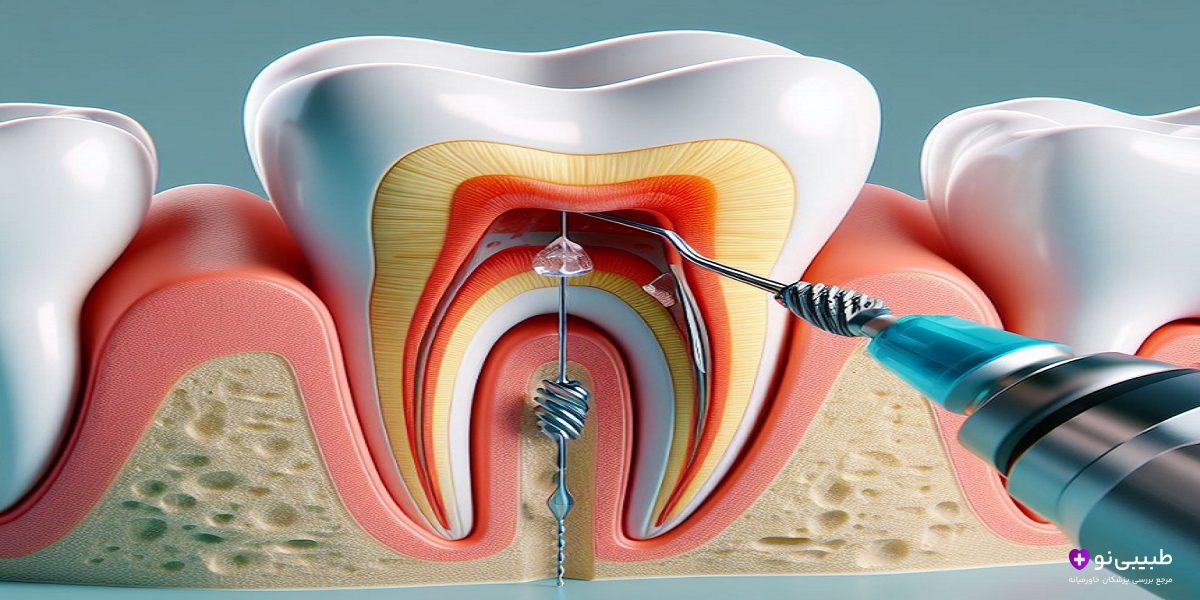 فرق درمان ریشه دندان با عصب‌کشی