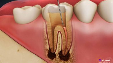 عفونت دندان عصب کشی شده بعد از چند سال