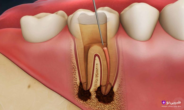 عفونت دندان عصب کشی شده بعد از چند سال