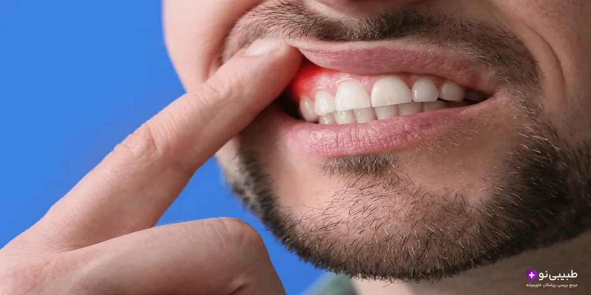 علت خونریزی لثه هنگام مسواک زدن