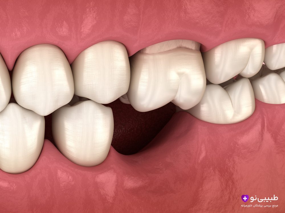برای جمع شدن لثه بعد از کشیدن دندان چه باید کرد؟