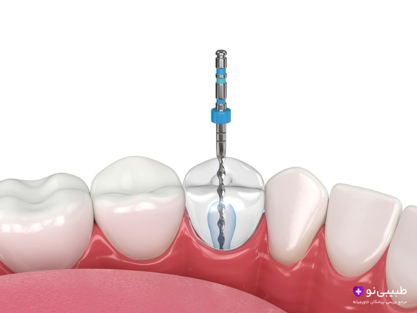 درد دندان بعد از عصب‌ کشی