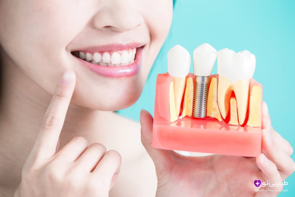 چه مدت بعد از کشیدن دندان باید ایمپلنت کرد؟