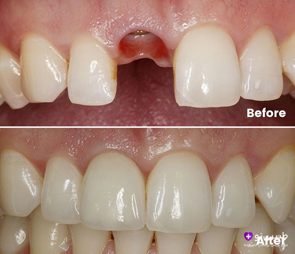 ایمپلنت دندان جلو چقدر طول میکشد؟