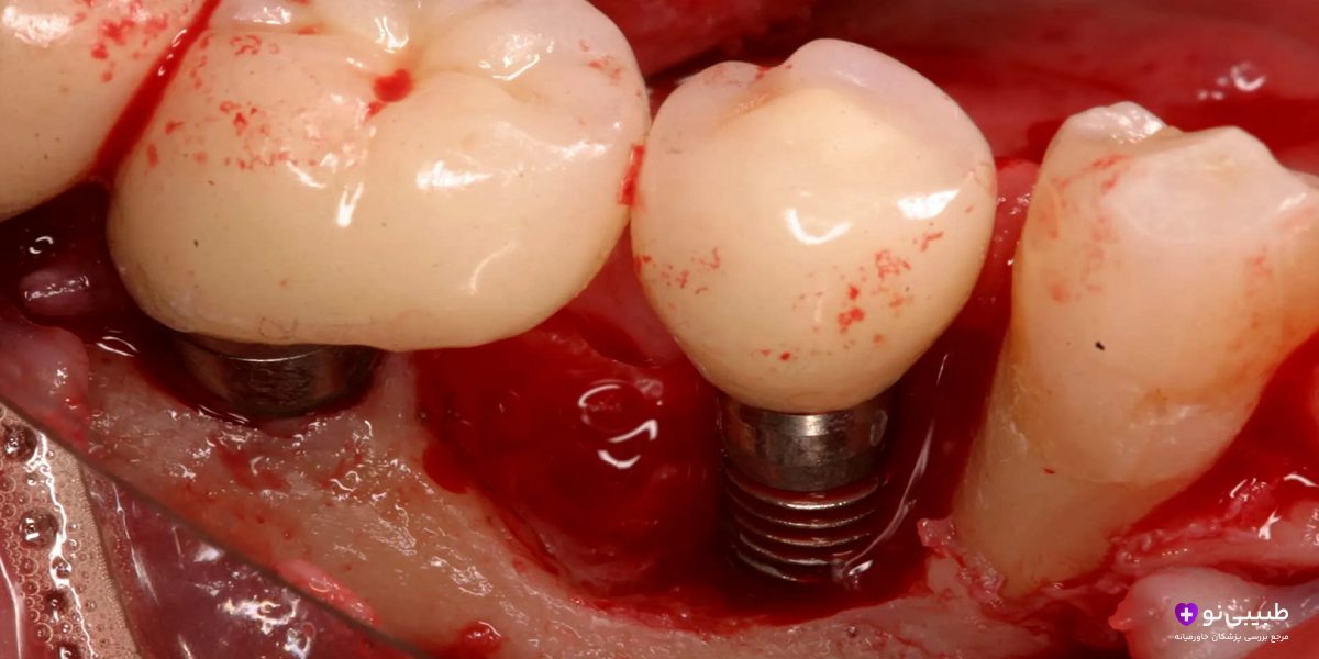 آیا ایمپلنت باعث سرطان می‌شود؟