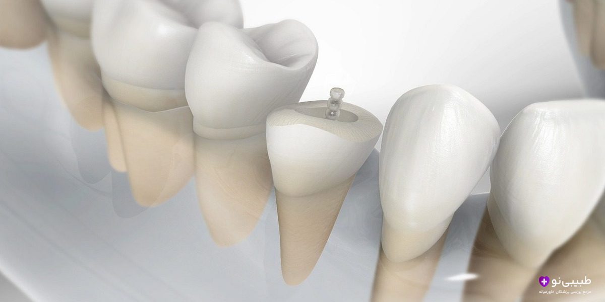 پست دندان بهتر است یا ایمپلنت