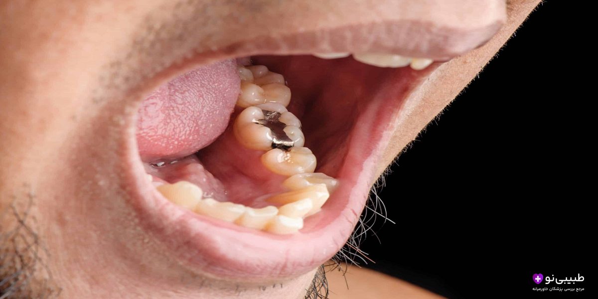 مراحل پر کردن دندان با آمالگام