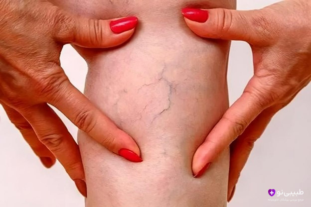 بهترین راه درمان و پیشگیری از واریس را در طبیبی نو بدانید.