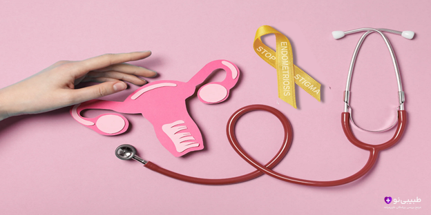 نشانههای اندومتریوز شدید در بانوان و راه های درمان اندومتریوز در طبیبی نو