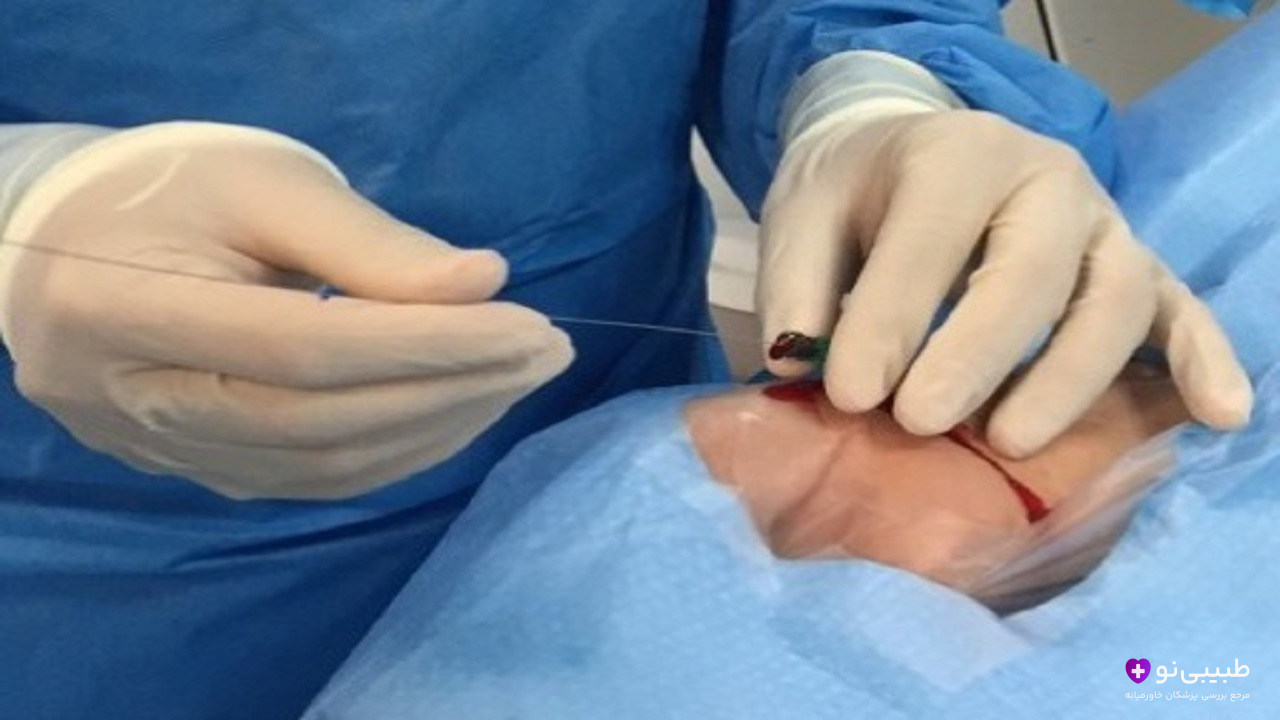 آنژیوگرافی مغز