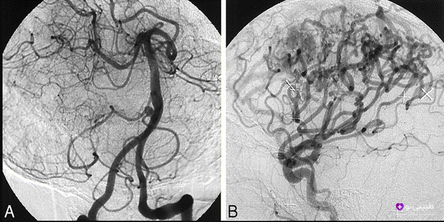 آنژیوگرافی مغز معمولاً یک روش ایمن است، اما مانند هر عمل پزشکی، خطراتی از جمله خونریزی یا واکنش به مواد کنتراست وجود دارد.