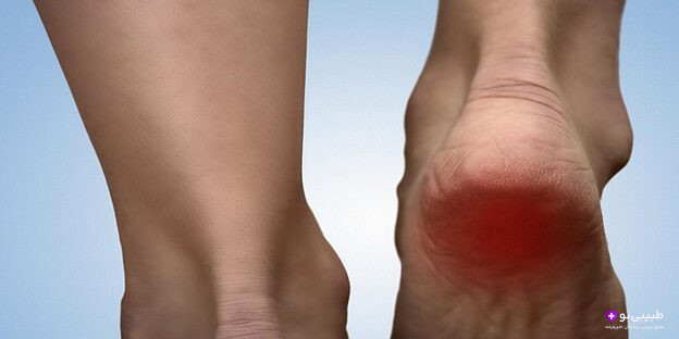 درد پاشنه پا میتواند نشانهای از کمبود ویتامین باشد. در این مقاله ارتباط بین کمبود مواد مغذی و درد پاشنه را بررسی کرده و راهکارهای درمانی مؤثر را معرفی میکنیم.