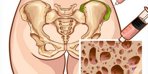 تصویر فرآیند پیوند مغز استخوان برای درمان سرطان خون و اختلالات خونی