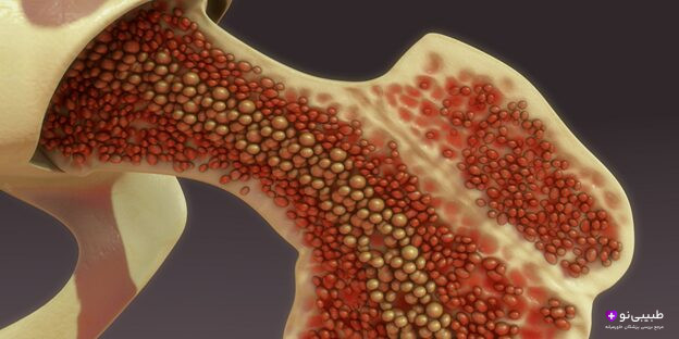 نمای شماتیک میلوم متعدد در مغز استخوان با سلولهای پلاسما سرطانی