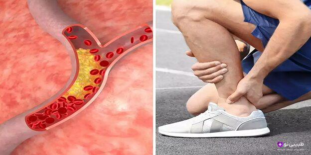 آیا کلسترول بالا میتواند باعث درد پاشنه پا شود؟ در این مقاله، ارتباط بین کلسترول بالا و درد پاشنه پا را بررسی کرده و راهکارهای پیشگیری و درمان را ارائه میدهیم.