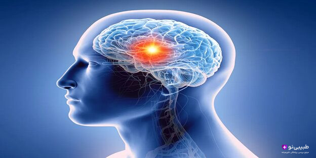 نقشه حرارتی فعالیت مغز در بیماران مبتلا به وسواس فکری
