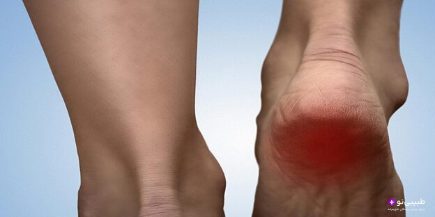 درد پاشنه پا هنگام راه رفتن میتواند دلایل مختلفی مانند التهاب فاسیای کف پا یا خار پاشنه داشته باشد. در این مطلب با علل رایج و روشهای مؤثر درمان آشنا شوید.