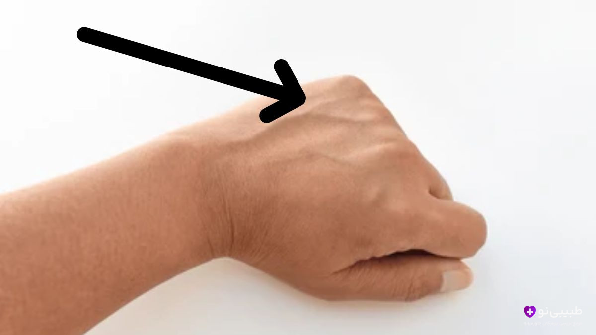 دست سالم و بدون رگهای برجسته - نمونهٔ دست طبیعی که نشاندهندهٔ کبد چرب نیست (برای مقایسه با رگهای برجسته در بیماریهای پیشرفته کبدی)