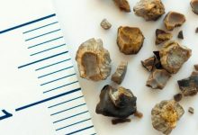 انواع سنگ کلیه بر اساس رنگ
