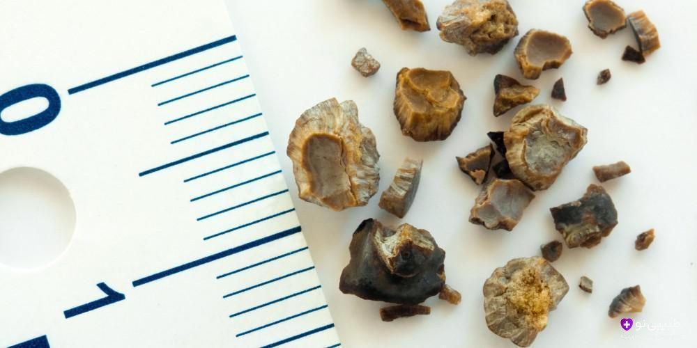 انواع سنگ کلیه بر اساس رنگ