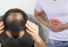 درمان ریزش مو ناشی از کبد چرب