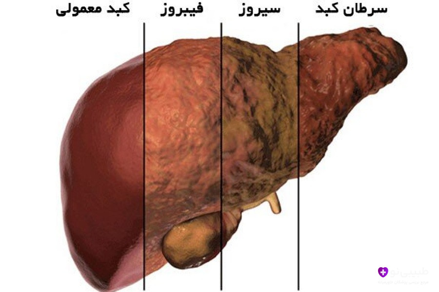 انواع کبد چرب