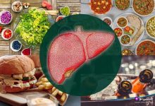 برای کبد چرب چی بخوریم چی نخوریم