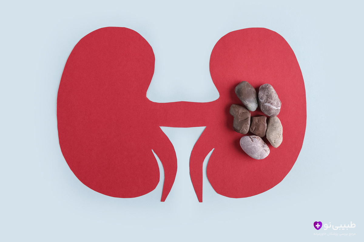 مراقبتهای بعد از سنگ شکن کلیه با لیزر