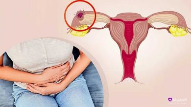 محل قرارگیری جنین در بارداری خارج از رحم