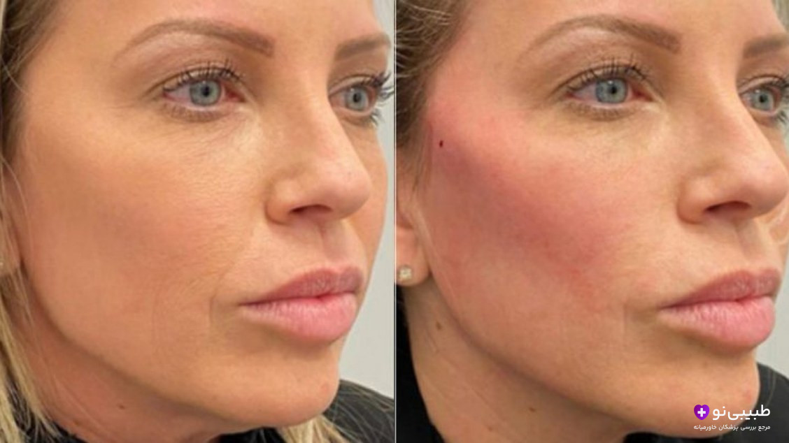نمونه کاره چهره زن بعد از لیفت صورت با نخ