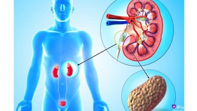 تصویر سه‌بعدی مرد آبی‌رنگ با کلیه‌های قرمز و سنگ کلیه زرد در کلیه راست، همراه جزئیات عروق و مثانه