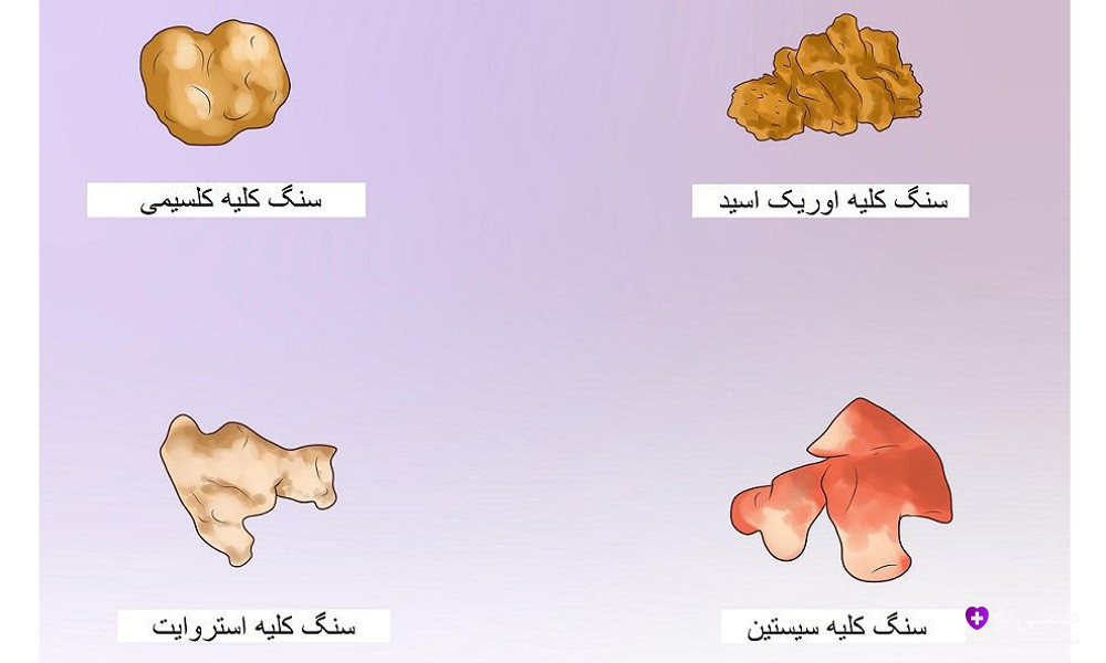 اینفوگرافیک بنفش انواع سنگ کلیه: کلسیم اگزالات (قهوهای)، اسید اوریک (گردویی)، استروویت (صورتی)، سیستین (قرمز) با برچسبهای فارسی