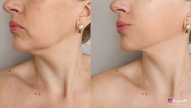 مقایسه گردن و چانه زن قبل و بعد از درمان افتادگی پوست