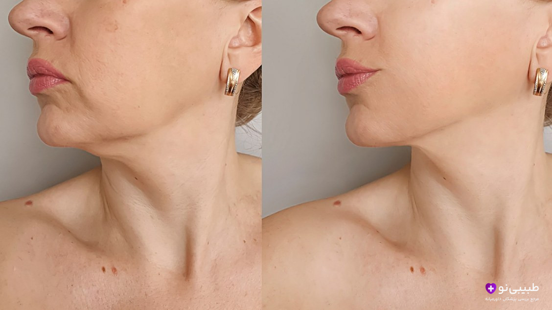 مقایسه گردن و چانه زن قبل و بعد از درمان افتادگی پوست