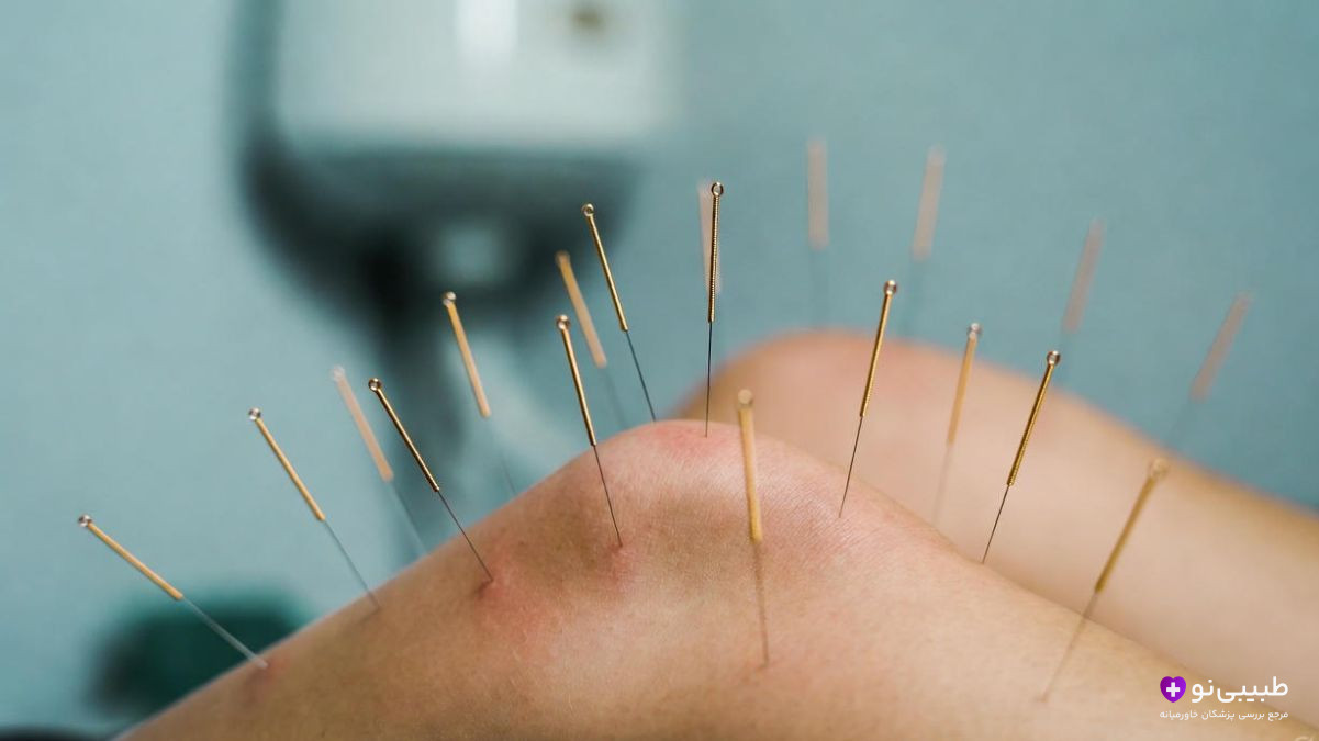 طب سوزنی روی زانو برای تسکین درد و التهاب آرتروز