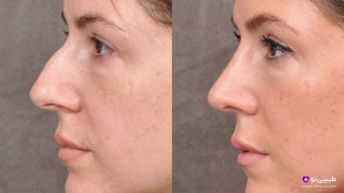 قبل و بعد رینوپلاستی کامل از نمای نیم‌رخ | تفاوت رینوپلاستی با تیپ پلاستی در تغییر پل بینی، قوز و نوک بینی