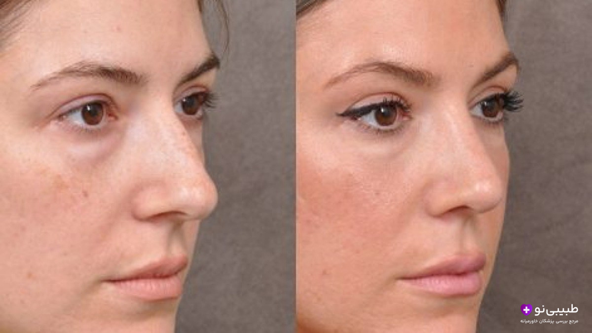 قبل و بعد تیپ پلاستی بینی از نمای نیم‌رخ | تفاوت رینوپلاستی و تیپ پلاستی در اصلاح نوک بینی و زاویه نوک با لب