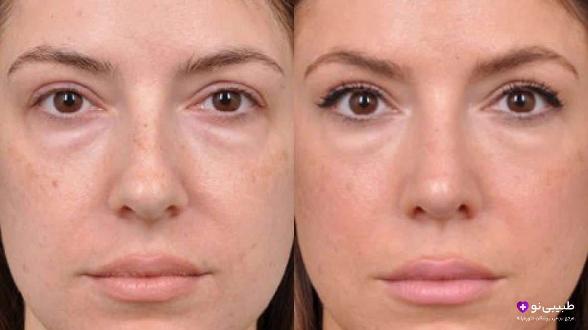 قبل و بعد تیپ پلاستی بینی در مقایسه با رینوپلاستی کامل | تفاوت تغییر فقط نوک بینی با جراحی کامل بینی