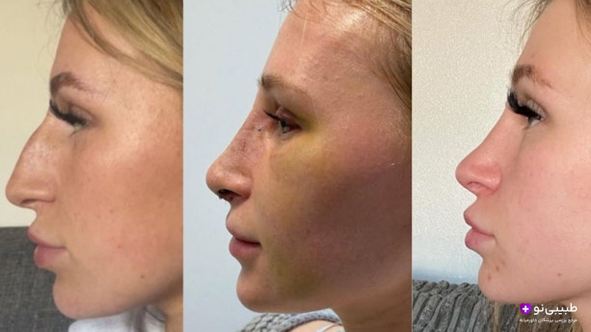 سه مرحله عمل بینی از نیمرخ: چپ) قبل عمل با بینی طبیعی و پوست سالم؛ وسط) بلافاصله پس از عمل با کبودی شدید، تورم و زردی زیر چشم؛ راست) پس از بهبودی کامل با بینی کوچک، صاف و پوست شفاف