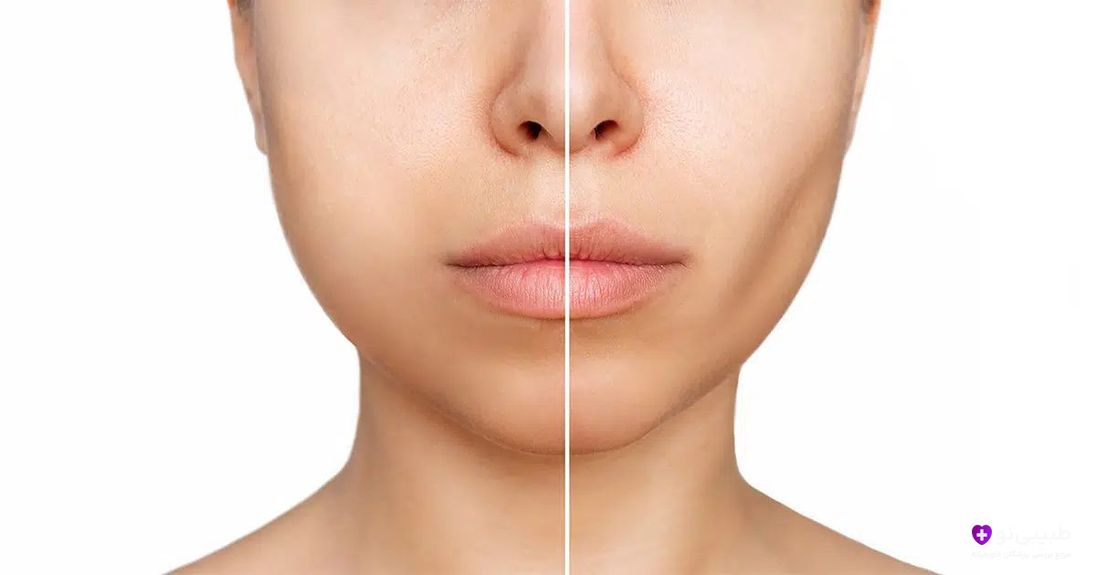 مقایسه قبل و بعد بوکال فت ریمووال و حذف چربی زیر چانه