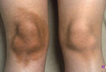 دو زانوی در کنار هم، یکی با تیرگی قابل توجه روی پوست و دیگری طبیعی، روی زمینه روشن