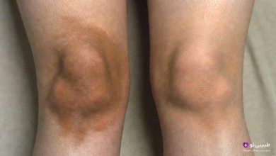 دو زانوی در کنار هم، یکی با تیرگی قابل توجه روی پوست و دیگری طبیعی، روی زمینه روشن