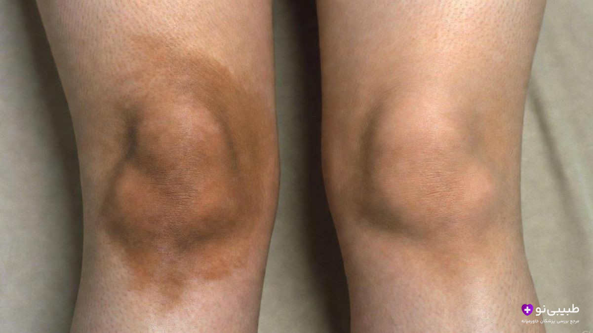 دو زانوی در کنار هم، یکی با تیرگی قابل توجه روی پوست و دیگری طبیعی، روی زمینه روشن