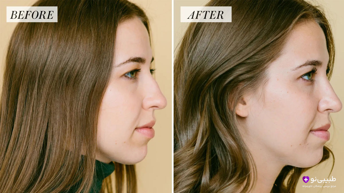 نمای نیمرخ دختر جوان با موهای قهوهای؛ سمت چپ بینی پهن و افتاده با برچسب BEFORE و سمت راست بینی سربالا و قوسدار با برچسب AFTER