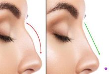 مقایسه نوک بینی افتاده قبل (چپ) و نوک بینی سربالا پس از رینوپلاستی (راست)