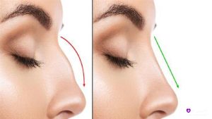 مقایسه نوک بینی افتاده قبل (چپ) و نوک بینی سربالا پس از رینوپلاستی (راست)
